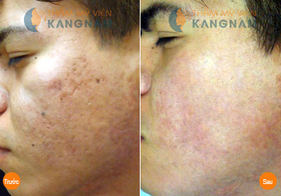 Hình ảnh trước và sau khi trị sẹo
