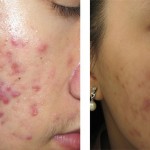 5 cách trị sẹo thâm lâu năm hiệu quả mà đơn giản tại nhà