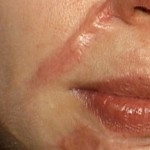 Làm thế nào để xóa sẹo lồi do phẫu thuật sứt môi?