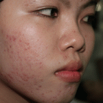 Bị sẹo lõm do trị tàn nhang không đúng cách, phải làm sao?