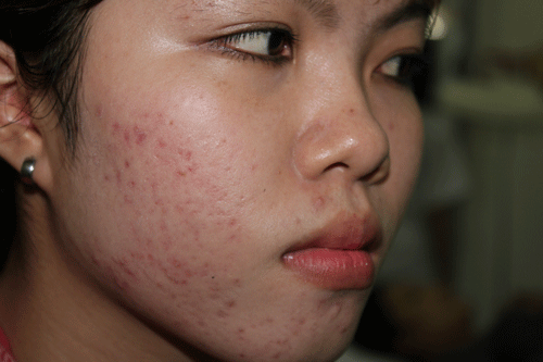 Bị sẹo lõm do trị tàn nhang không đúng cách, phải làm sao?