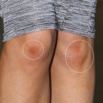 Bí kíp trị sẹo thâm lâu năm ở chân “cực” hiệu quả