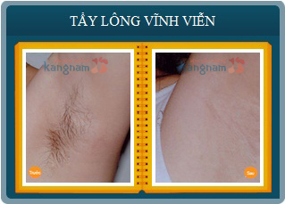 Hình ảnh trước sau triệt lông vĩnh viễn