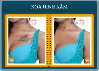 Hỉnh ảnh trước sau xóa xăm