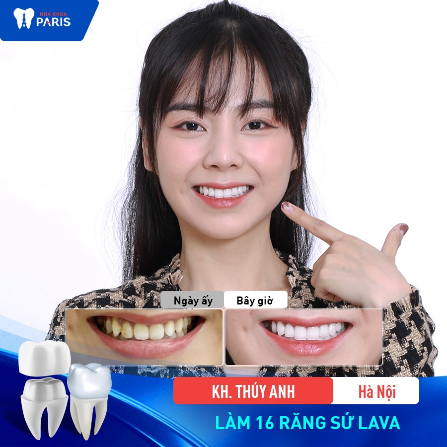 Bọc răng đẹp, trắng sáng cho khách hàng tại Paris