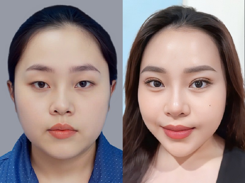 Khách hàng sở hữu mắt 2 mí cân đối, to tròn