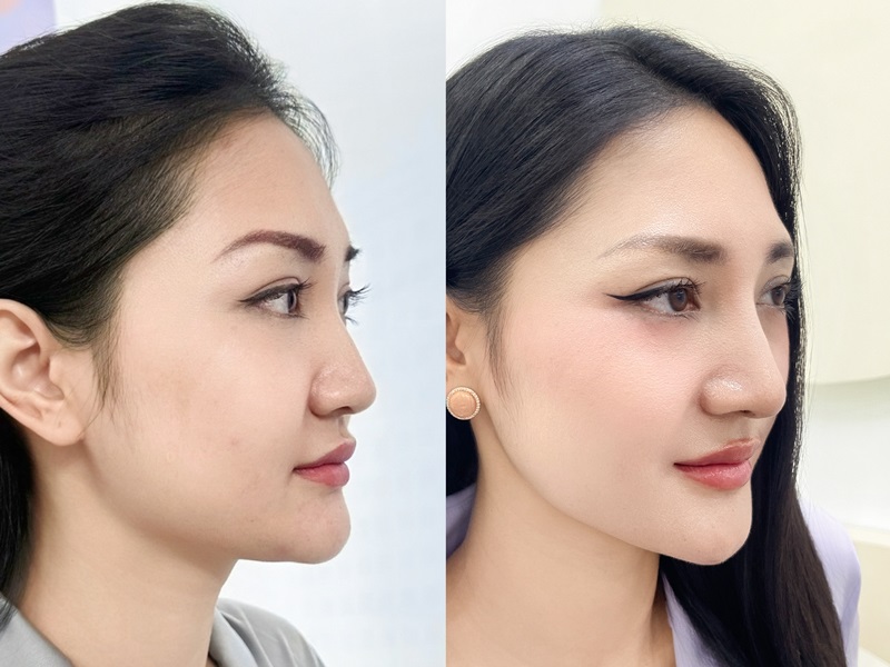 Nâng mũi Idol giúp khách hàng sở hữu dáng mũi cao, thanh thoát