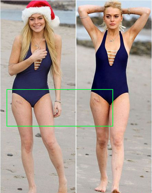 Lindsay Lohan vô tư khoe sẹo